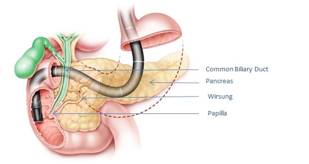 Hình 1. Hình ảnh nội soi ở tá tràng, đối diện với nhú tá tràng; ống mật hiển thị bằng màu xanh lá cây và ống tụy hiển thị bằng màu nâu.